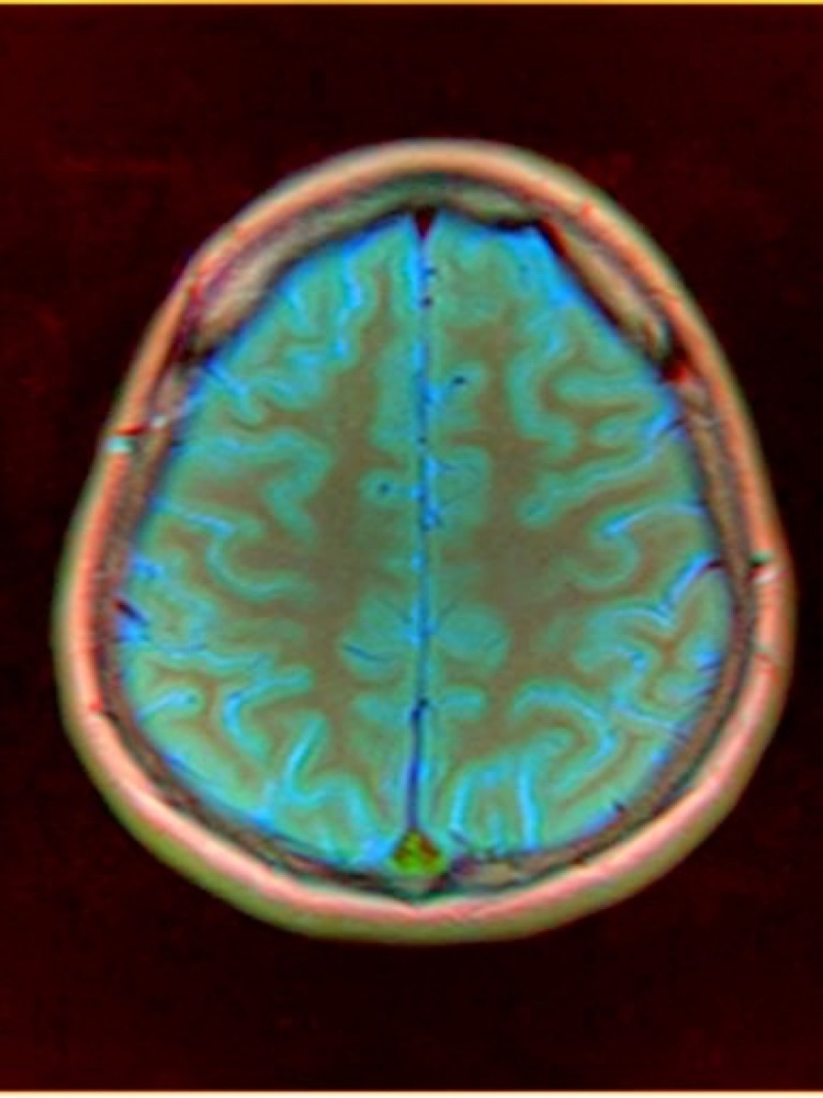 Színes agyi MRI-felvétel – neurológia